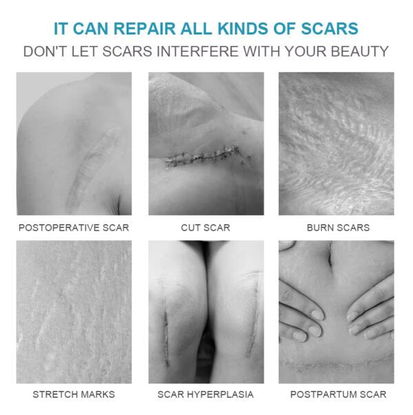 Repair Cream Lightening Ointment Cold Compress Gel Smooth Repair Scar Cream Scar Disapear Remove Gel - Image 7