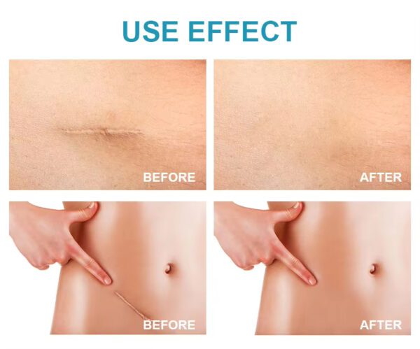 Repair Cream Lightening Ointment Cold Compress Gel Smooth Repair Scar Cream Scar Disapear Remove Gel - Image 6